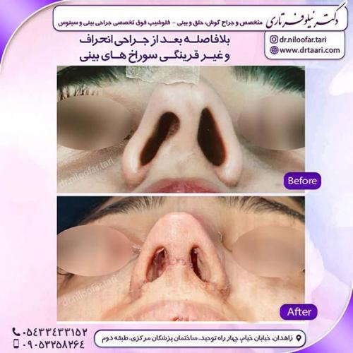 جراحی-بینی-132