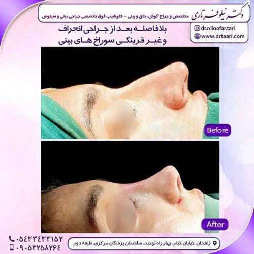 جراحی-بینی-133