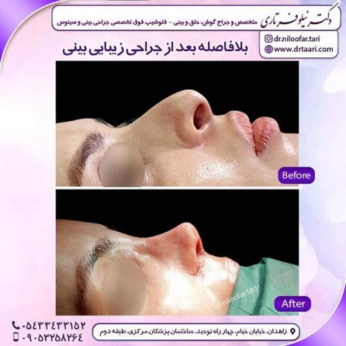 جراحی-بینی-134