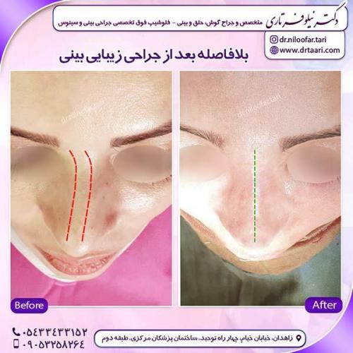 جراحی-بینی-135
