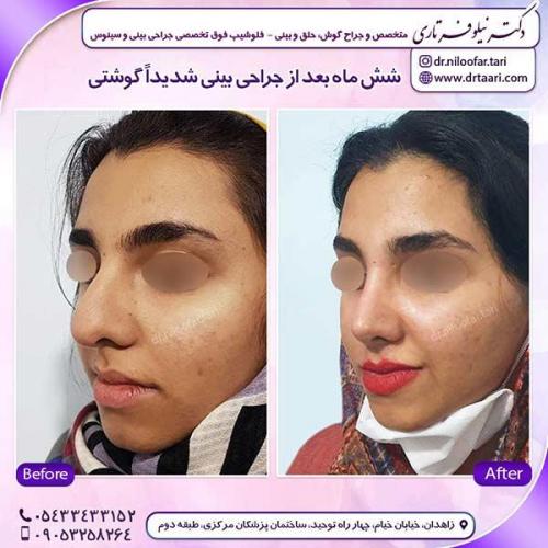جراحی-بینی-136