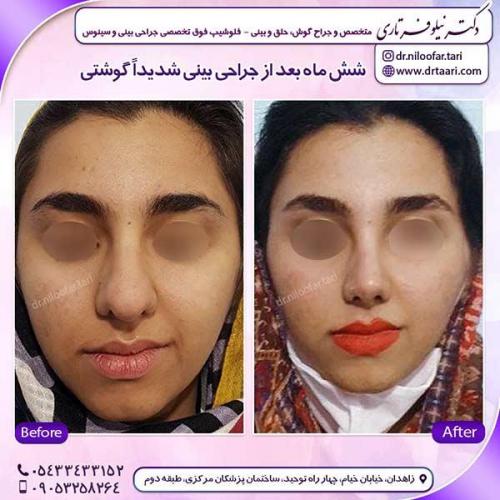 جراحی-بینی-137