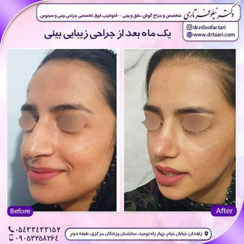 جراحی-بینی-138