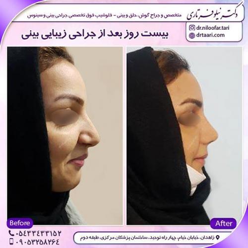 جراحی-بینی-14
