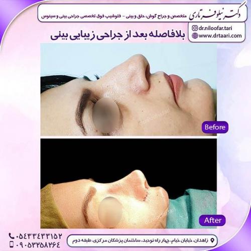 جراحی-بینی-140