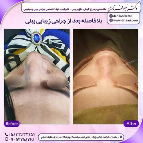 جراحی-بینی-141