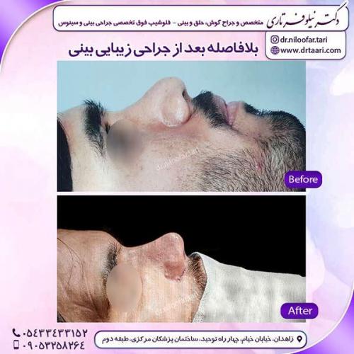 جراحی-بینی-142