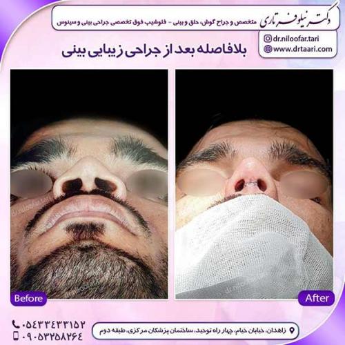 جراحی-بینی-143