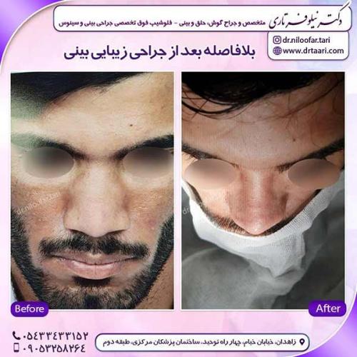 جراحی-بینی-144