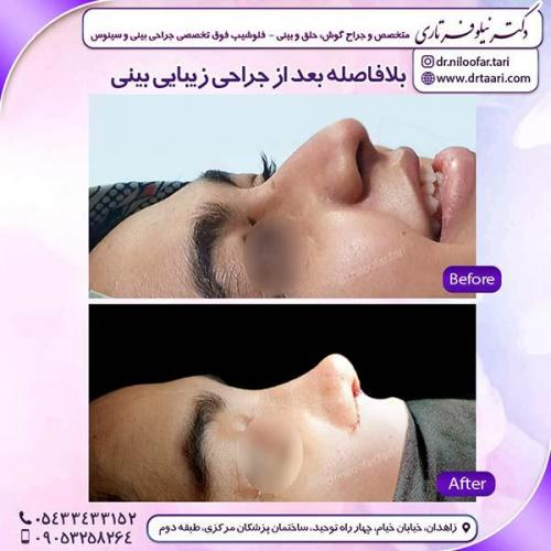 جراحی-بینی-145