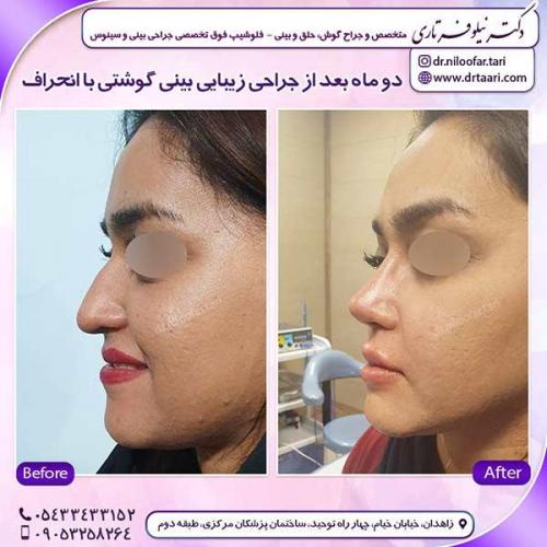 جراحی-بینی-148