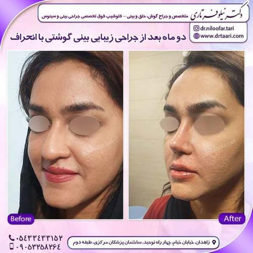 جراحی-بینی-149
