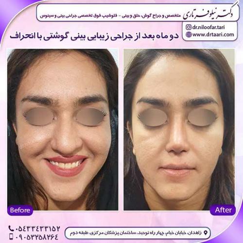 جراحی-بینی-150