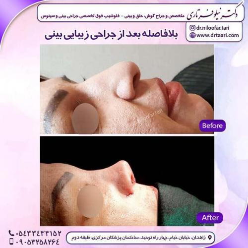 جراحی-بینی-151
