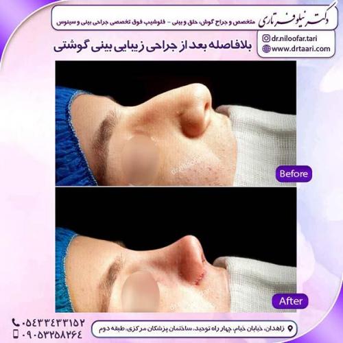 جراحی-بینی-152