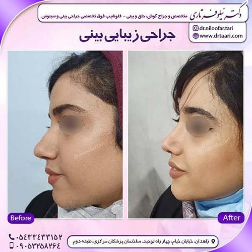 جراحی-بینی-153