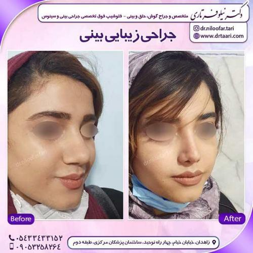 جراحی-بینی-154