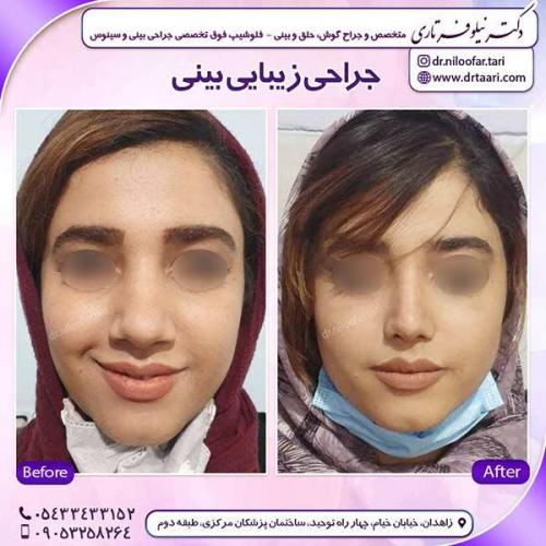 جراحی-بینی-155