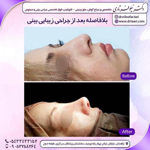 جراحی-بینی-156