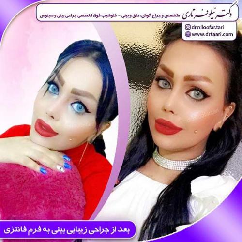 جراحی-بینی-157