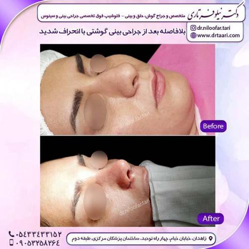 جراحی-بینی-159