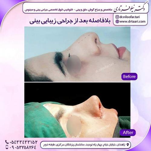 جراحی-بینی-161