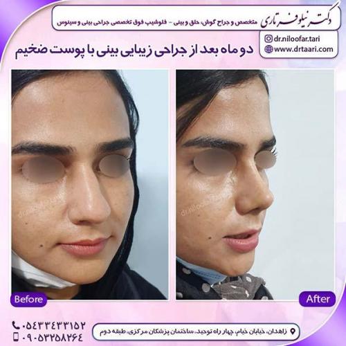 جراحی-بینی-163
