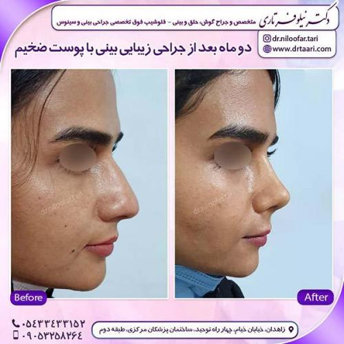 جراحی-بینی-164