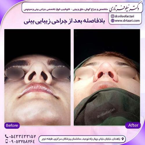 جراحی-بینی-167