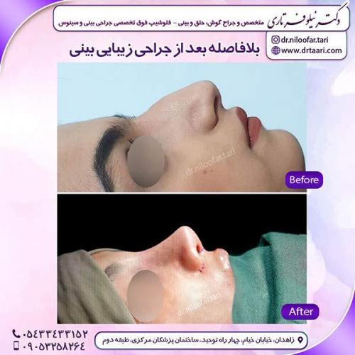 جراحی-بینی-169