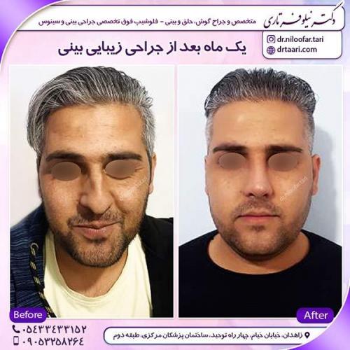 جراحی-بینی-17