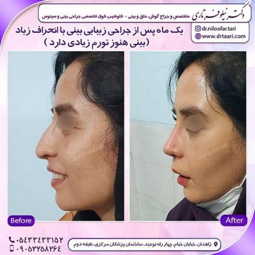 جراحی-بینی-170