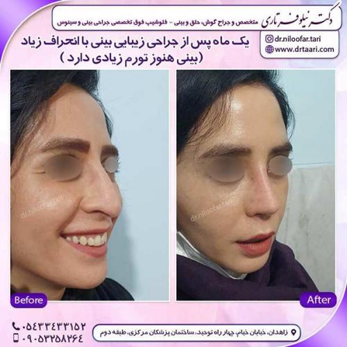 جراحی-بینی-171