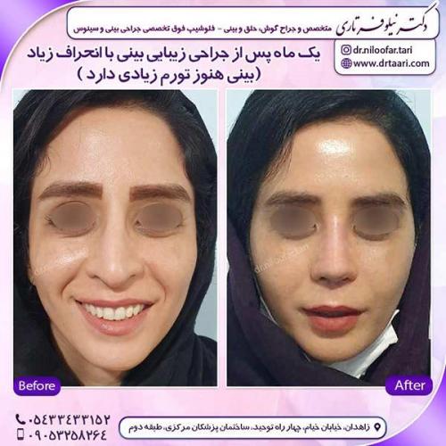 جراحی-بینی-172