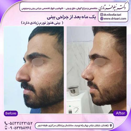 جراحی-بینی-174