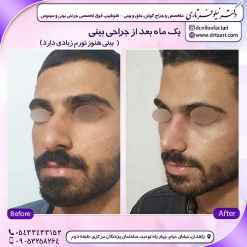 جراحی-بینی-175