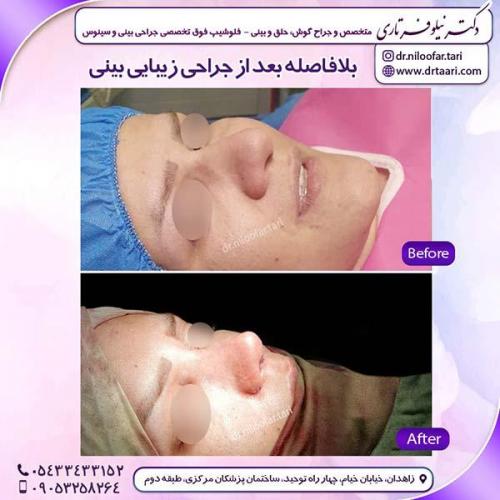 جراحی-بینی-176