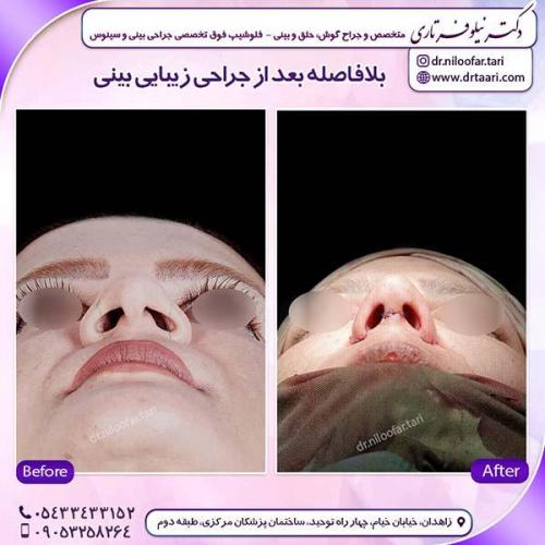 جراحی-بینی-177