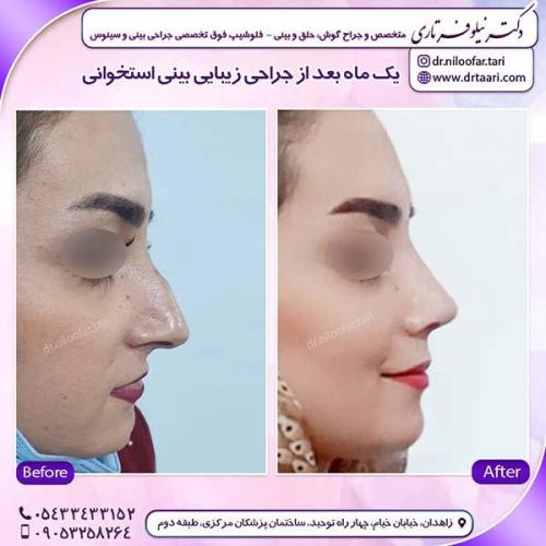 جراحی-بینی-178