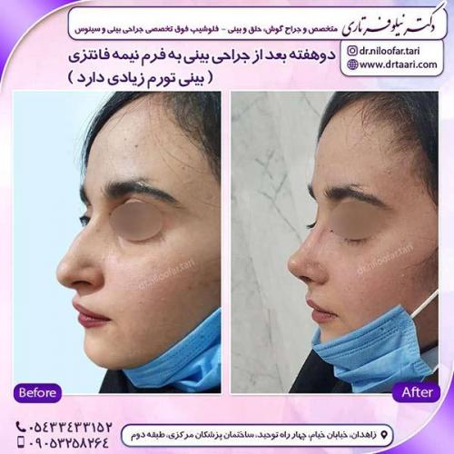 جراحی-بینی-179