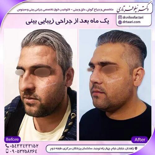 جراحی-بینی-18