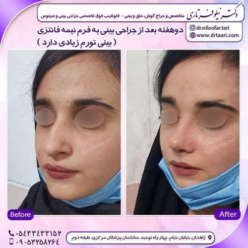 جراحی-بینی-180