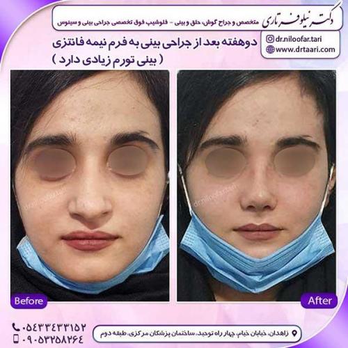 جراحی-بینی-181