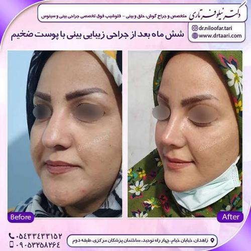 جراحی-بینی-182