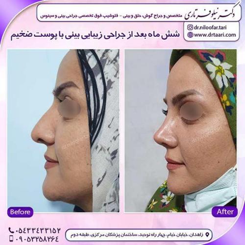 جراحی-بینی-184