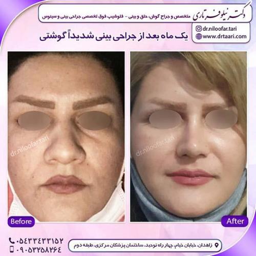 جراحی-بینی-185