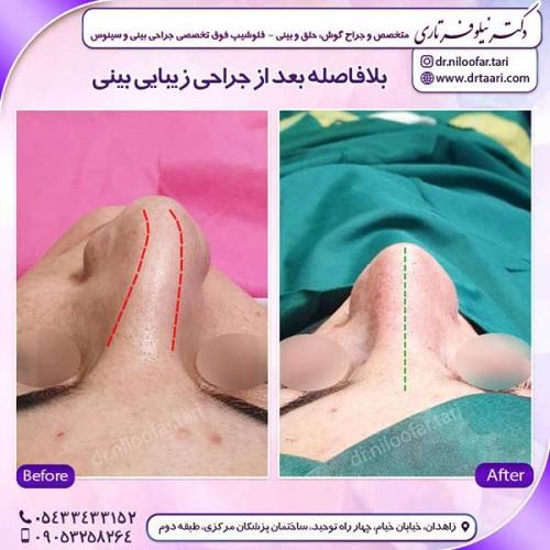 جراحی-بینی-186
