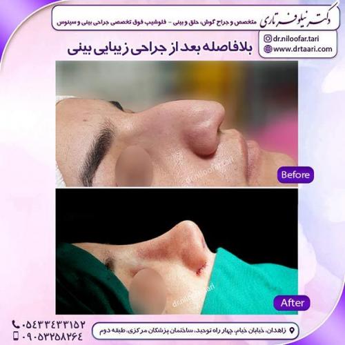 جراحی-بینی-187