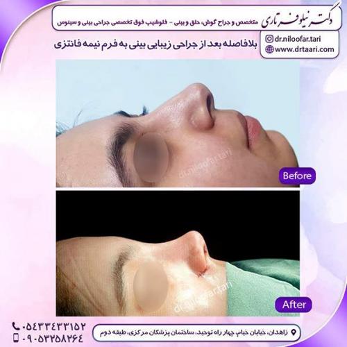 جراحی-بینی-188