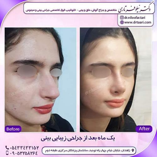 جراحی-بینی-189